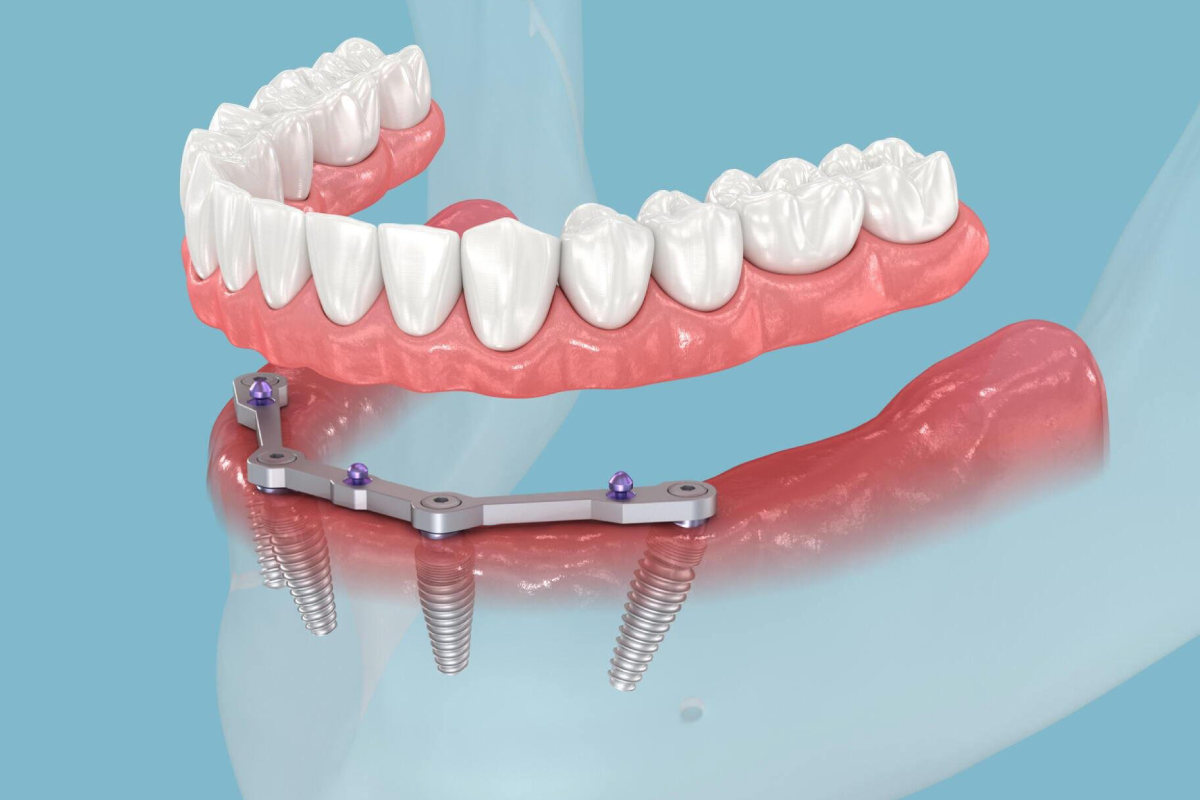 All on Four implant nedir?