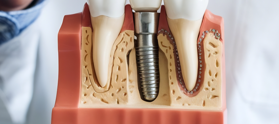 İmplant Fiyatları ? İmplant Fiyatları ?