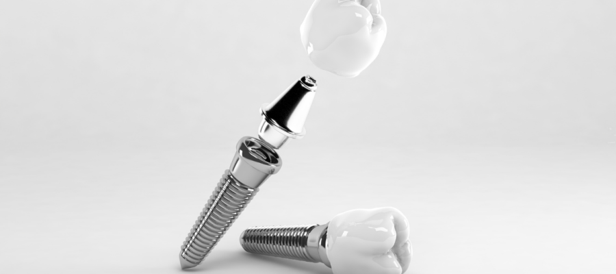 Diş İmplantı Nedir? Kimler İçin Uygundur? Diş İmplantı Nedir? Kimler İçin Uygundur?