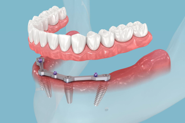All-On-Four implant nedir?