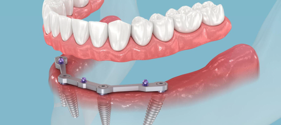 All-On-Four implant nedir? All-On-Four implant nedir?