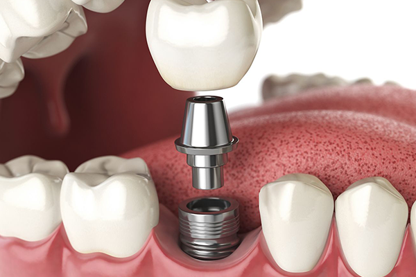 IMPLANTATBEHANDLUNG