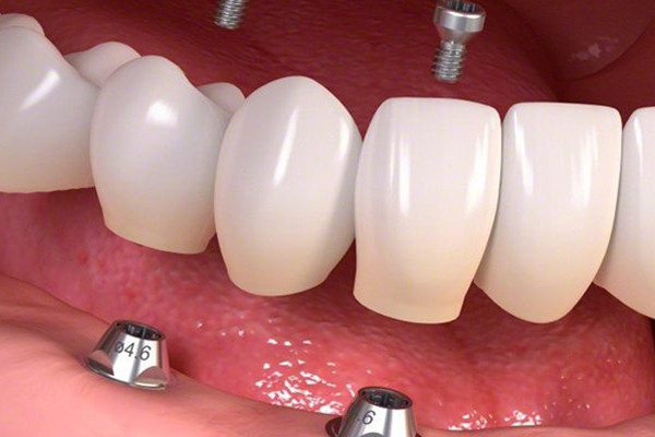 Implantatgetragene Prothesen