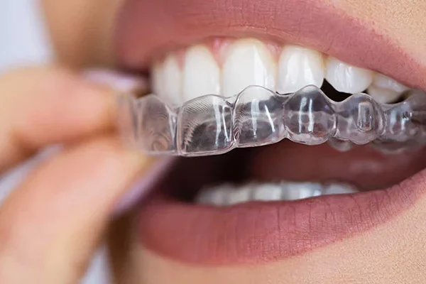 Invisalign