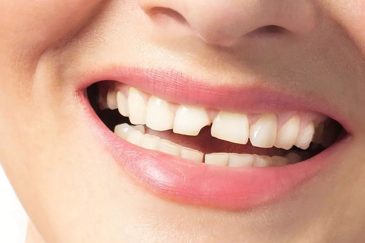 Kırık Diş Tedavisi