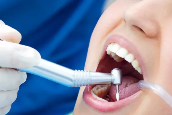 Diş Dolgusu Sonrası Nelere Dikkat Edilmeli?