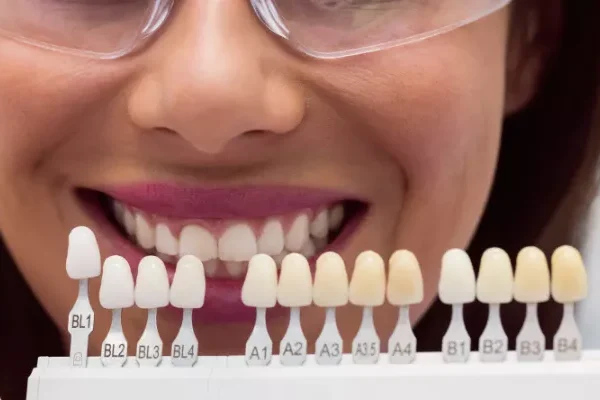 Emax Kaplama Seçmeden Önce Bu Detayları Bilin